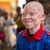 Chinsisi Jafali, a 14-year-old with albinism in Malawi