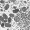 Monkeypox é uma infecção rara, mas perigosa, semelhante ao vírus da varíola agora erradicado