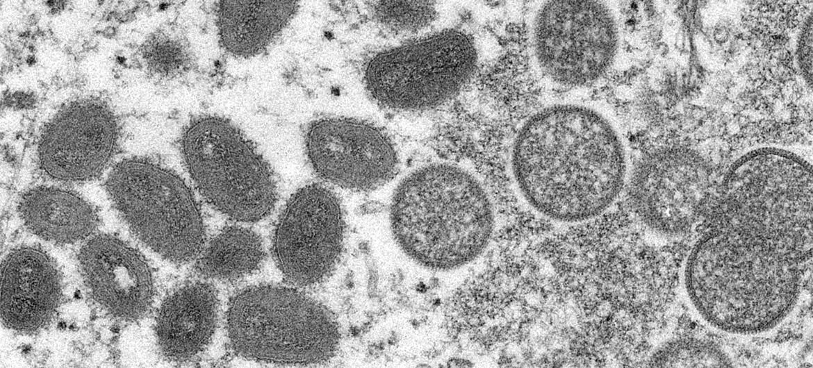 Le monkeypox est une infection rare mais dangereuse semblable au virus de la variole maintenant éradiqué. 