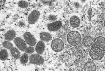 Virusi vya Monkeypox vinakaribia vile vya surua.