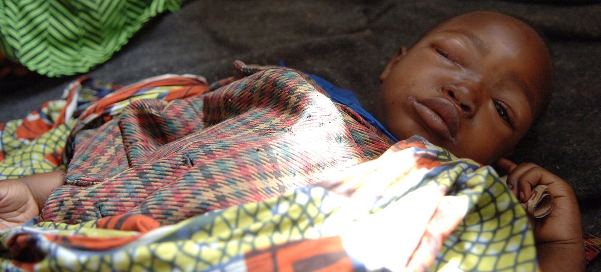 काँगो लोकतांत्रिक गणराज्य (DRC) में विस्थापित लोगों के लिये उत्तर कीवू में बनाए गए एक स्वास्थ्य केन्द्र में, मंकीपॉक्स से संक्रमित एक पाँच वर्षीय बच्चा.