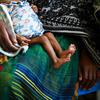طفل يعاني من سوء تغذية حاد في أحد العيادات الطبية بإثيوبيا.
