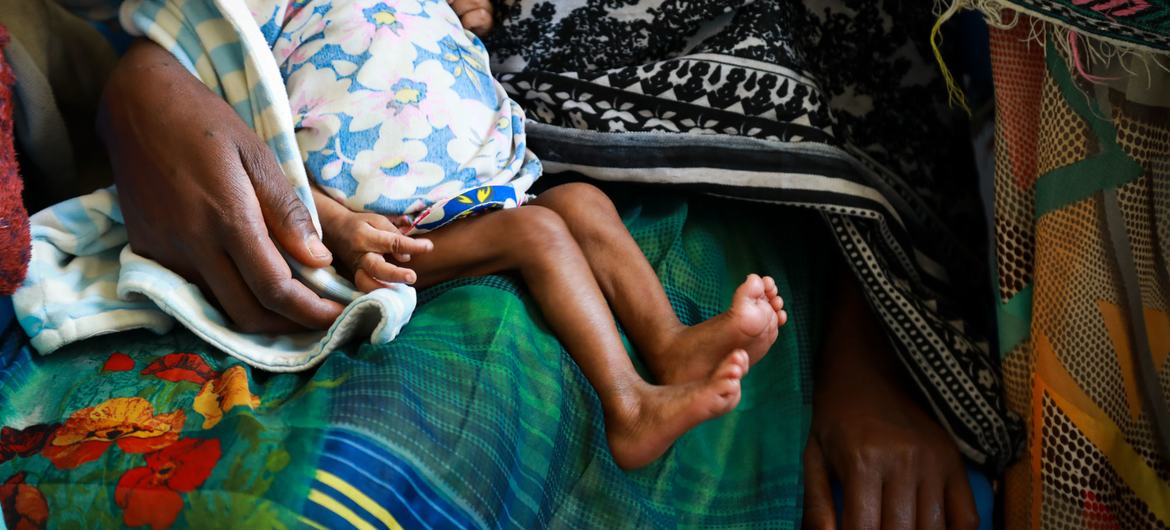 इथियोपिया के एक क्लीनिक में, गम्भीर कुपोषण से पीड़ित एक बच्चे की तस्वीर.