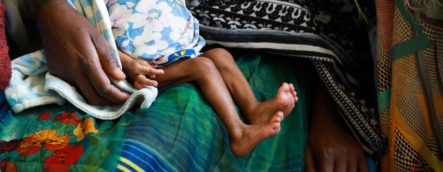 Un enfant souffrant de malnutrition sévère dans une clinique en Éthiopie.