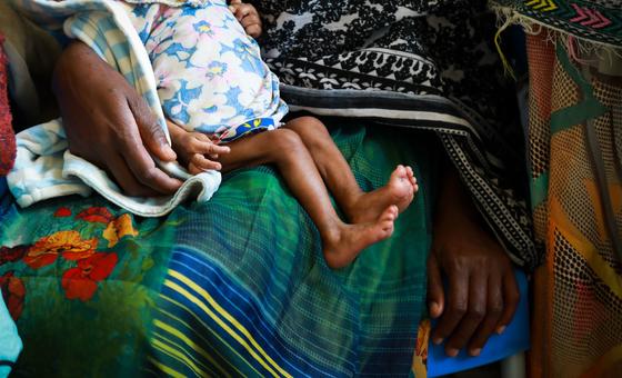Сильно истощенный ребенок в клинике в Эфиопии.