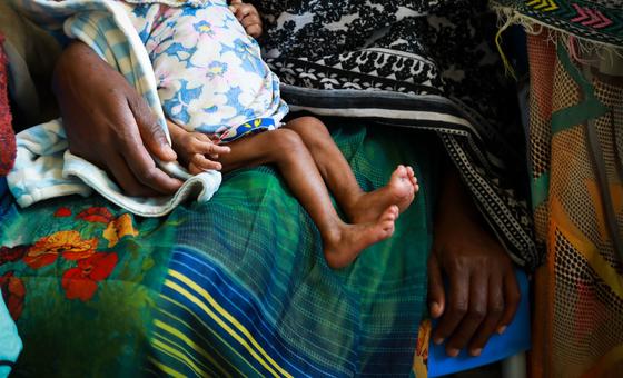 A severely malnourished child at a clinic in Ethiopia