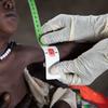 दक्षिण सूडान में एक स्वास्थ्यकर्मी, गम्भीर कुपोषण के शिकार एक बच्चे का, पोषण स्तर मापते हुए.