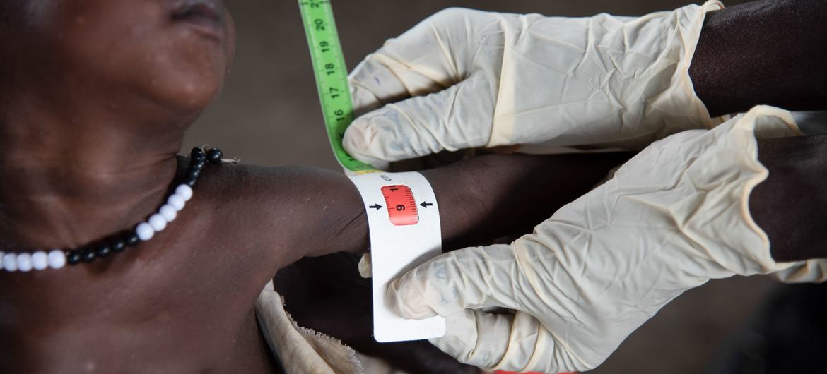 عاملة تغذية تقيس ذراع طفل يعاني من سوء التغذية الحاد في عيادة في جنوب السودان.