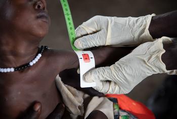 一名营养工作者在南苏丹的一家诊所测量一名严重营养不良婴儿的臂围。