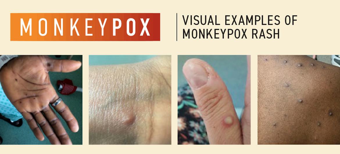 L'OMS surveille de près la propagation de la variole du singe.