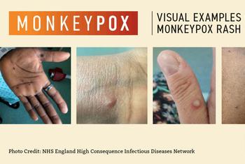 L'OMS surveille de près la propagation de la variole du singe.