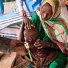 一名一岁女童在索马里多娄的一家由粮食署资助的诊所接受营养不良治疗。