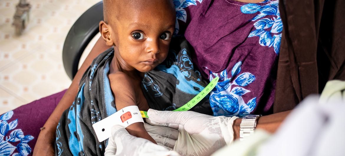 طفل يبلغ من العمر عامًا واحدًا يعاني من سوء التغذية الحاد يتم قياس محيط ذراعه في مستشفى في دولو ، إثيوبيا.