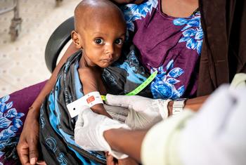 Este pequeño de un año con desnutrición grave recibe atención en un hospital de Dolow, Etiopía.