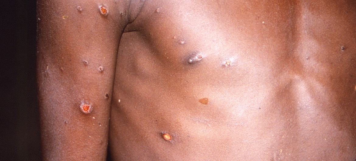 Monkeypox causes skin lesions, fever, and body aches in people affected by the virus.