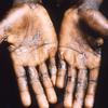Des lésions causées par la variole du singe apparaissant sur les paumes des mains.