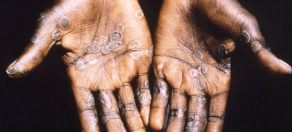 猴痘病变常出现在手掌上。