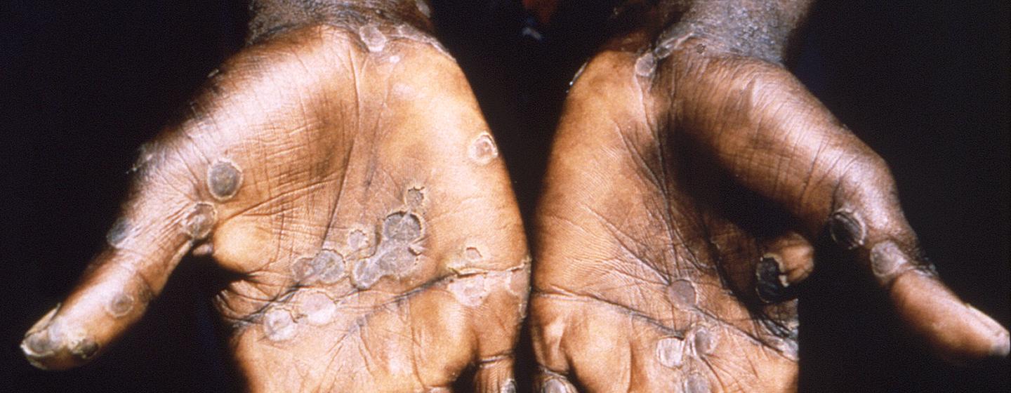Monkeypox lesions often appear on the palms of hands.