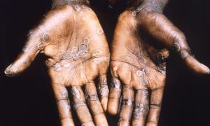 Monkeypox lesions often appear on the palms of hands.