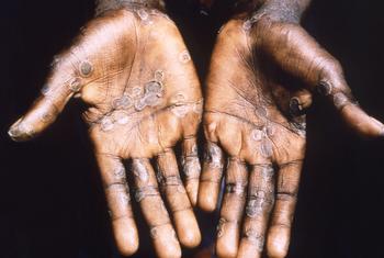 Lesões da varíola dos macacos geralmente aparecem nas palmas das mãos.