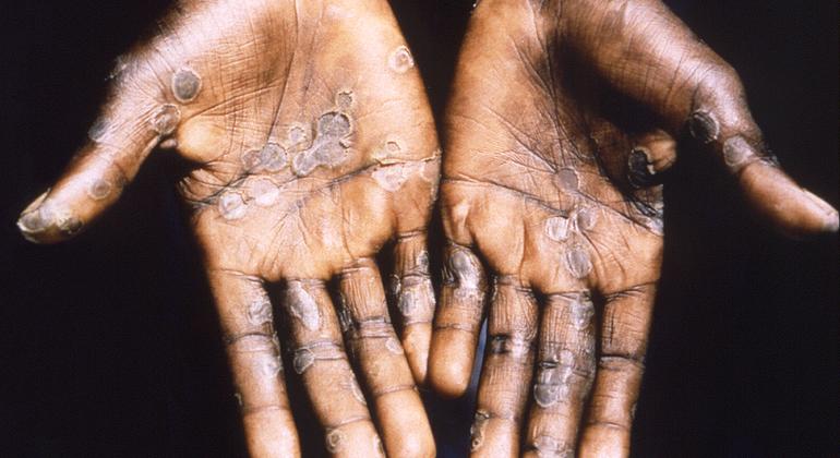 Las lesiones por viruela del mono suelen aparecer en las palmas de las manos.