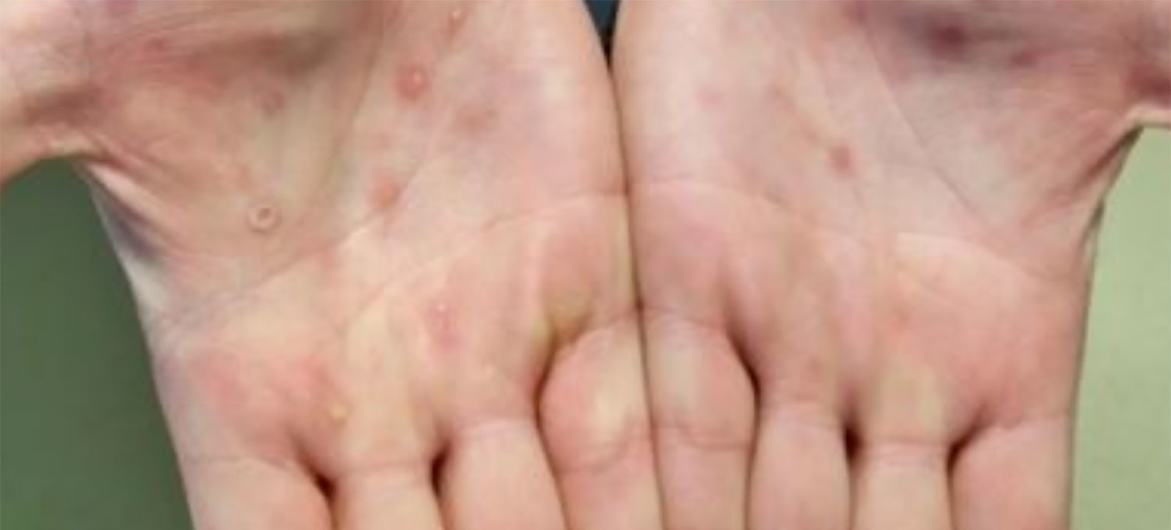 Monkeypox lesions usually appear on the palms of the hands.