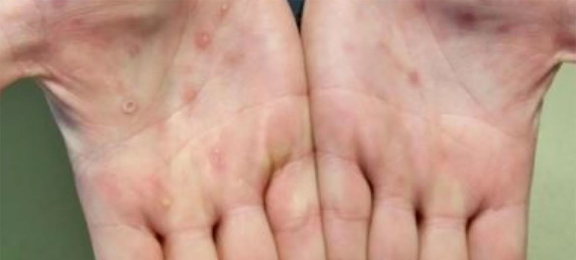 Monkeypox lesions often appear on the palms of hands.