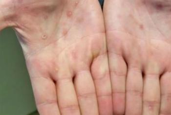 As lesões da varíola geralmente aparecem nas palmas das mãos.