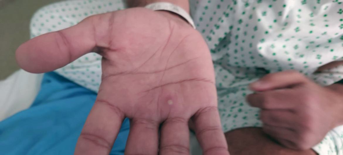 The monkeypox virus can be spread through direct exposure to lesions.