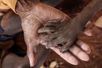 La main d'un enfant souffrant de malnutrition est posée sur les mains de sa grand-mère. L'enfant vit à Kobamirafo, à 50 minutes de marche du Centre de santé de base d'Ambohimalaza, dans la Région Androy au sud de Madagascar.
