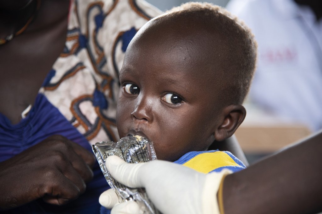أجابا أومباتشا (17 شهرا) يعاني من سوء تغذية حاد وخيم في جنوب السودان.
