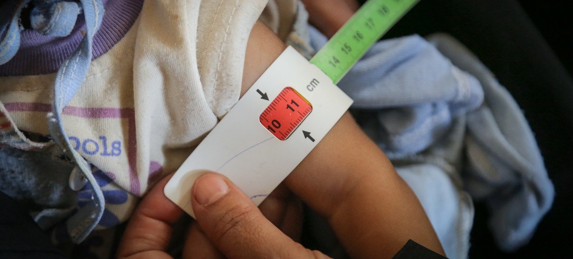قياس ذراع طفل يبلغ من العمر سبعة أشهر، في اليمن، للتحقق من معانته من سوء التغذية. لقد أدى الصراع المستمر إلى انتشار انعدام الأمن الغذائي في جميع أنحاء البلاد، مما تسبب في إصابة آلاف الأطفال بسوء التغذية الحاد والشديد.