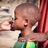 أنيسيو، طفل ولد مصابا بفيروس الإيدز، يعاني من مشاكل في العلاج بسبب سوء التغذية.