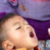 Vaccin antipoliomyélitique buccal administré à un enfant à Katmandou