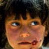 An Afghan girl with leishmaniasis