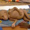 Severely malnourished child
