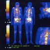 Whole body scan of patient being reviewed to assess the spread of cancer