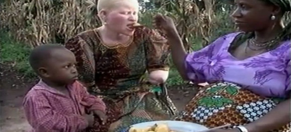Une femme albino de Tanzanie qui a été violemment assaillie en raison des rumeurs qui courraient sur ses supposés pouvoirs magiques.