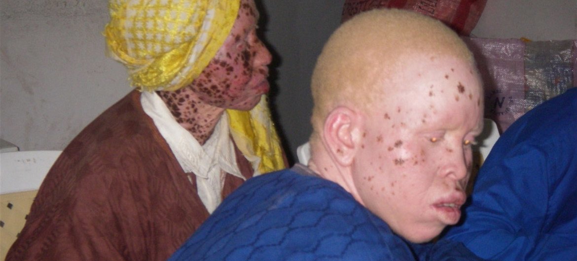 Joven senegalés con albinismo. Foto de archivo:  IRIN/Helen Blakesley