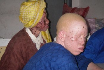 Devido à falta de melanina as pessoas com albinismo são altamente vulneráveis a adoecer de câncer de pele