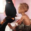 يعاني فيصل، 18 شهرا من العمر من سوء التغذية الحاد. مستشفى السبعين في العاصمة اليمنية صنعاء. المصدر: اليونيسف / UMI191723 / ياسين