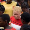 Albinism is a common genetic disorder in Equateur. Monieka, Democratic Republic of the Congo.
