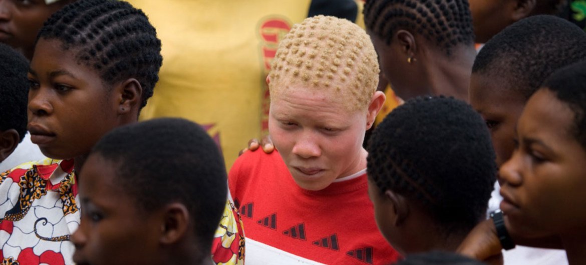  África Subsaariana tem uma em cada 1,4 mil pessoas vivendo com albinismo