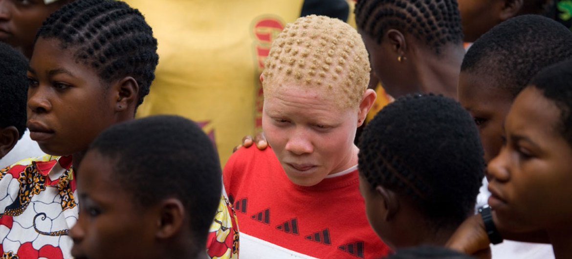 Albinism is a common genetic disorder in Equateur. Monieka, Democratic Republic of the Congo.