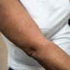 Não há vacina aprovada ou tratamento específico para a doença transmitida pelo mosquito aedes aegypti