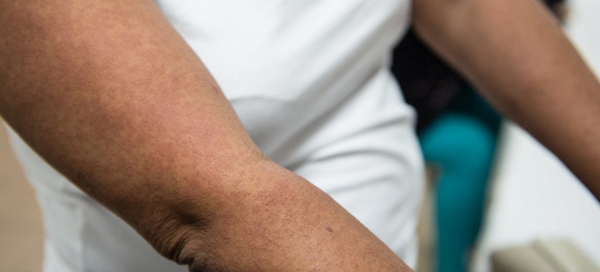 El virus del Zika se transmite por la picadura del mosquito Aedes. Foto: OMS/Luz Sosa