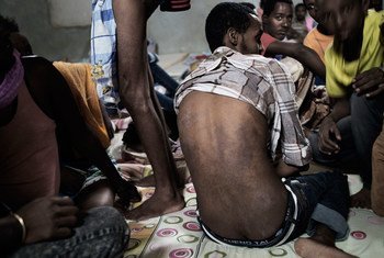 Un migrante de Eritrea muestra las enfermedades de la piel que contrajo en un centro de detención de Libia.
