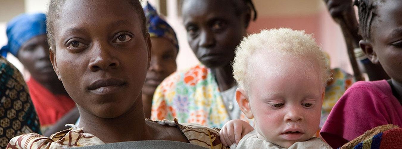一位非洲妇女正在照看一名遭到遗弃的白化病儿童。
