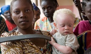 Une femme tient dans ses bras un enfant atteint d'albinisme à Goma, en République démocratique du Congo, en 2007. Photo ONU/Marie Frechon