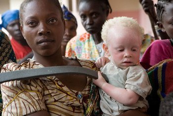 A caregiver attends to an abandoned toddler with albinism in Goma, North Kivu, DRC. 07 September 2007,